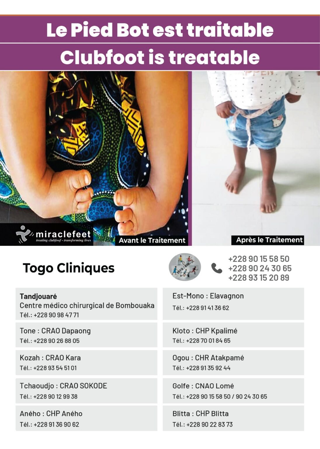 Les enfants âgés de 0 à 3 ans vont être soignés gratuitement du pied bot.
